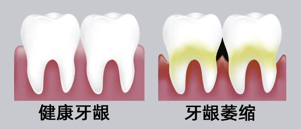 牙縫大露出“黑三角”，既塞牙又難看！還能恢復(fù)嗎？